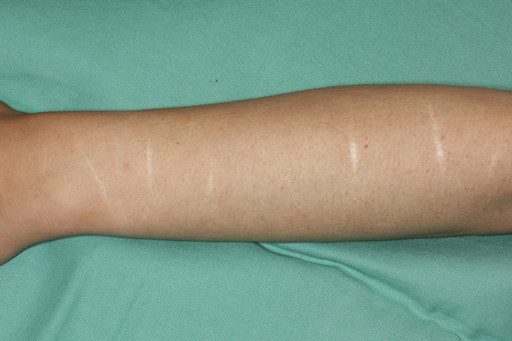 症例４ 左前腕部の瘢痕修正 リストカット 自由診療 傷跡治療 修正 東京の美容外科