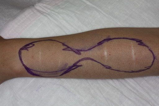 症例４ 左前腕部の瘢痕修正 リストカット 自由診療 傷跡治療 修正 東京の美容外科
