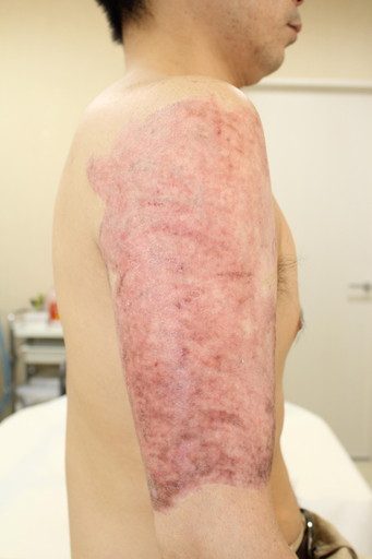 症例６ 削皮術 レーザー照射 肩 上腕 タトゥー除去 東京の美容外科