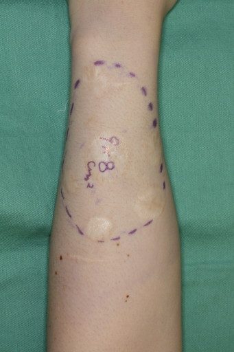 症例５ 左前腕部の瘢痕修正 根性焼き 自由診療 傷跡治療 修正 東京の美容外科