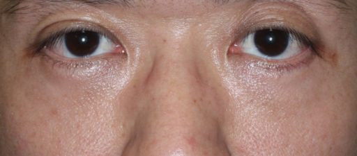 東京で目の下のたるみ取り クマ取りの手術ならティーズクリニックへ