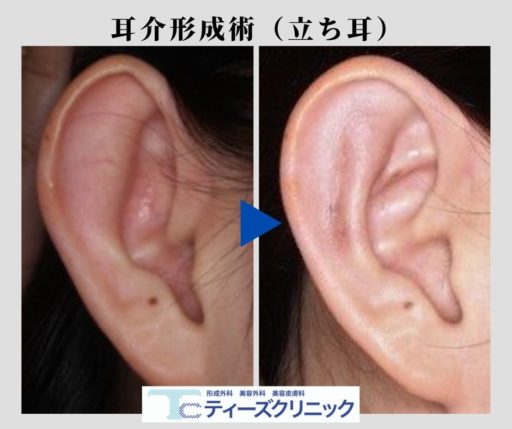 立ち耳 耳の悩みなら形成外科専門医の東京ティーズクリニックへ