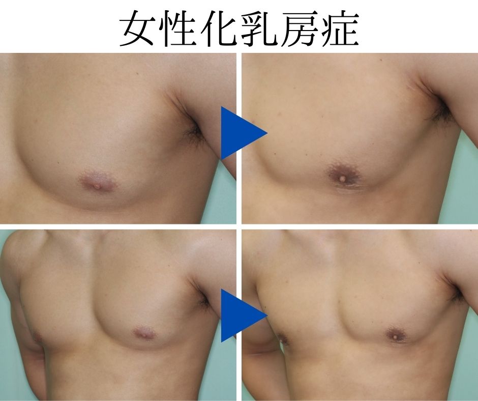 筋トレで鍛えた体の女性化乳房