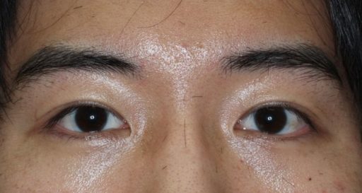 二重整形切開法 症例8 一重まぶたから末広型二重 男性