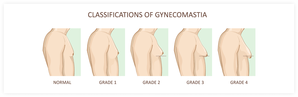 CLASSIFICATIONS OF GYNECOMASTIA