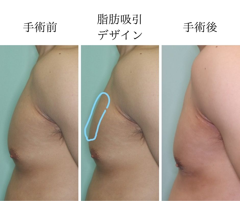 脂肪吸引および乳腺切除