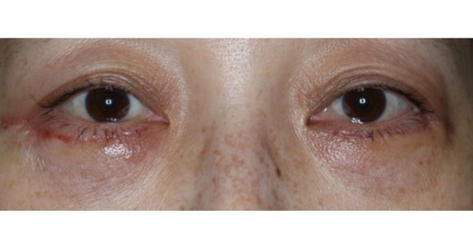 術後1週間・抜糸後