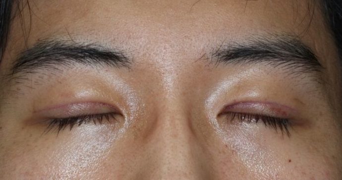 術後1週間 閉瞼