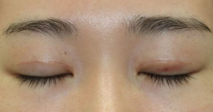 術後1ヶ月 閉瞼