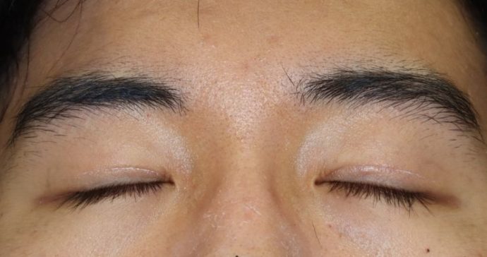 術後8ヶ月 閉瞼