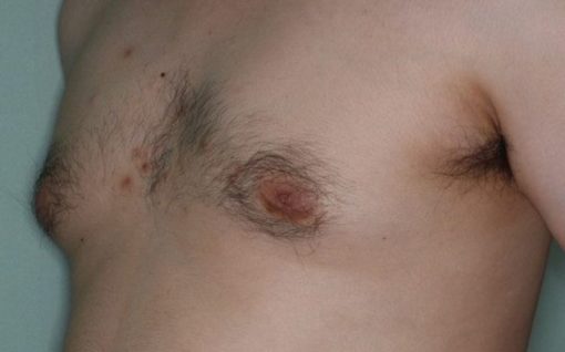 症例3 偽性女性化乳房(脂肪吸引) 術前