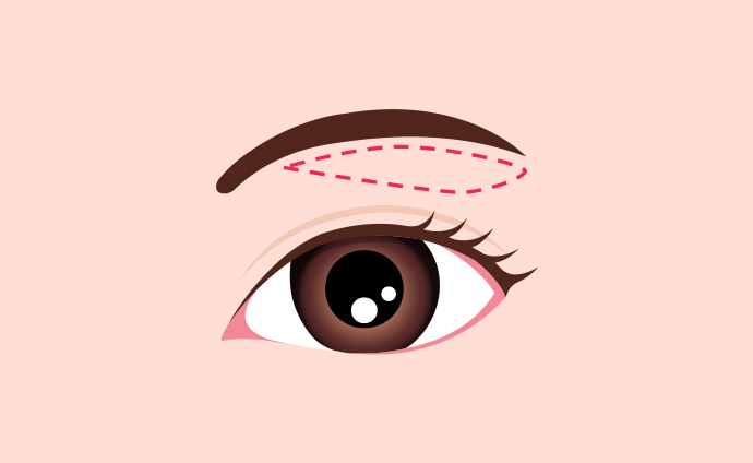 眉下切開法イラスト