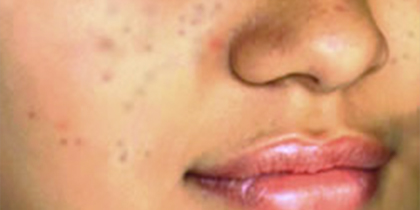 ライムライトに期待される効果 術前