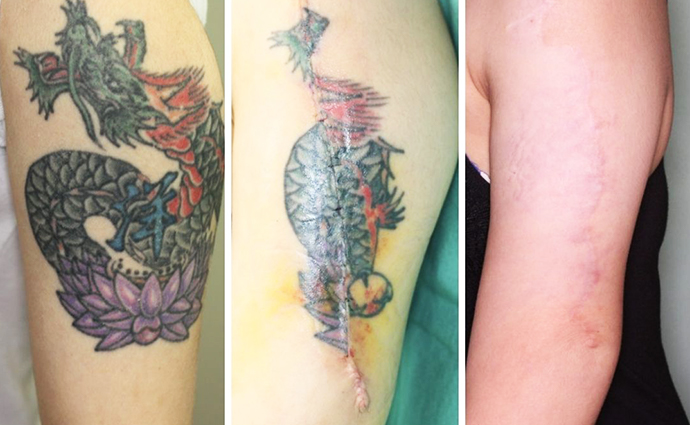 刺青・タトゥー除去（切除術）