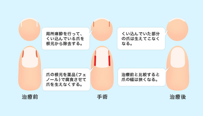 陥入爪