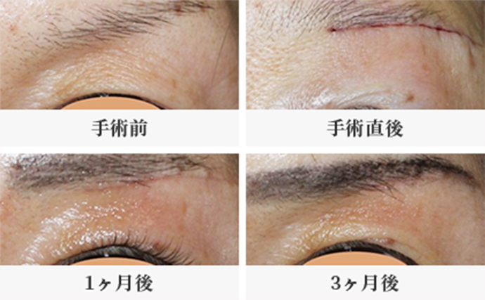 眉下切開法術前術後写真