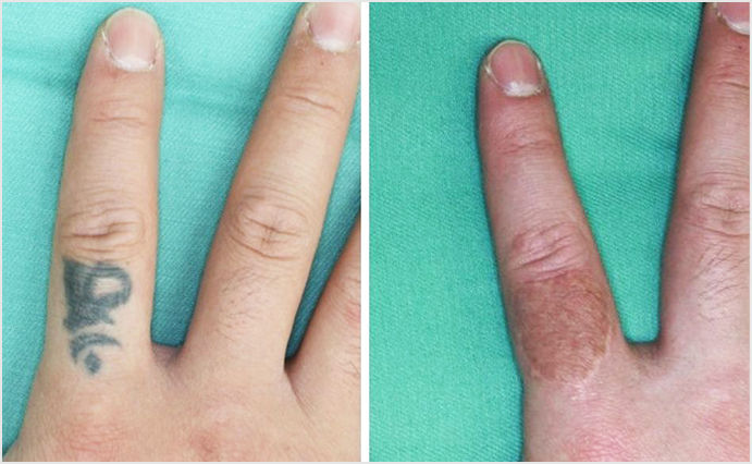 刺青・タトゥー除去（植皮術）