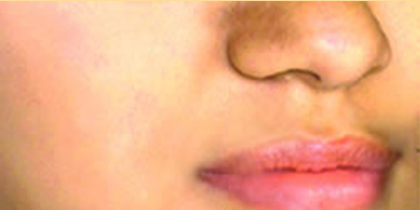 ライムライトに期待される効果 術後