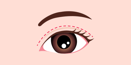 皮膚弛緩症手術 イラスト1