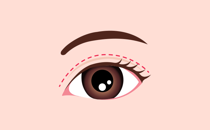 睫毛測切開法イラスト