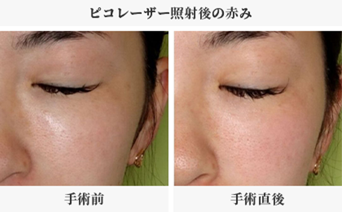 ピコレーザー照射後の赤み