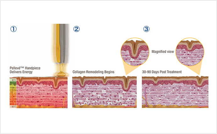 コラーゲンの収縮と再生成