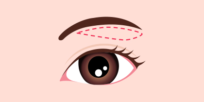 皮膚弛緩症手術 イラスト2