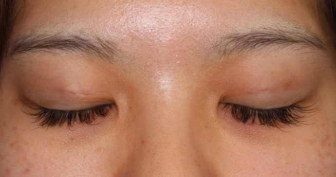 術後1ヶ月（閉瞼）