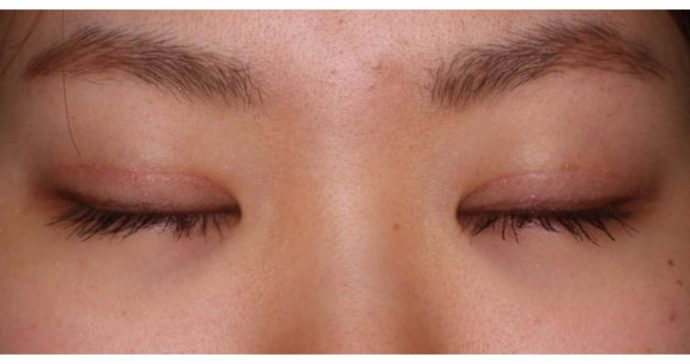 術後3ヶ月　閉瞼