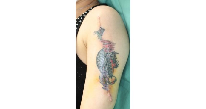 1回目タトゥー切除1週間後