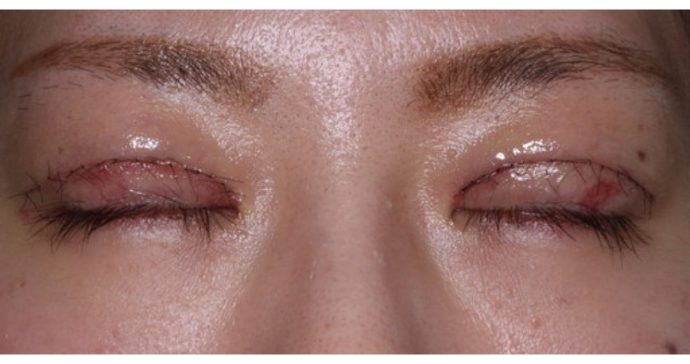 術後1週間 閉瞼