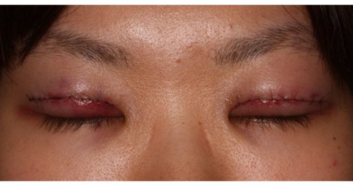 手術翌日　閉瞼