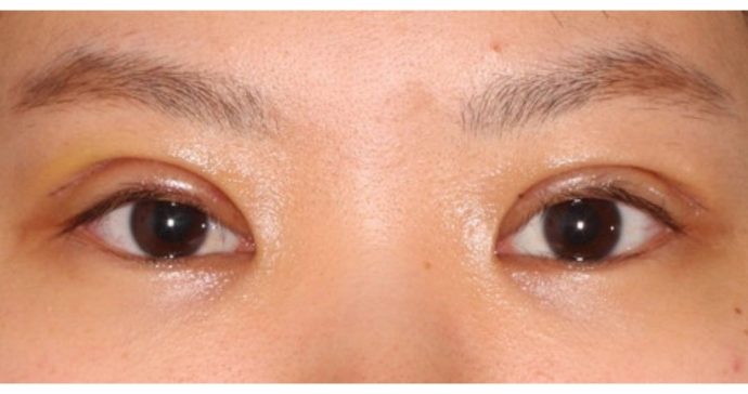 術後1週間　抜糸後