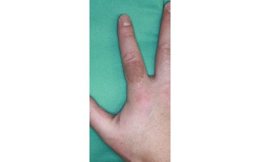 指のタトゥー除去・植皮術　術後