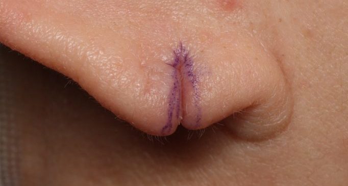 傷痕修正のデザイン