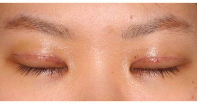 術後1週間　抜糸後　閉瞼