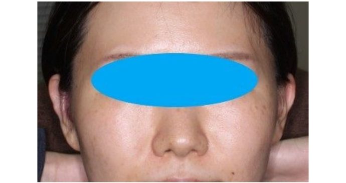 術後2ヶ月正面からの写真