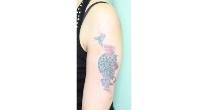 1回目タトゥー切除3週間後