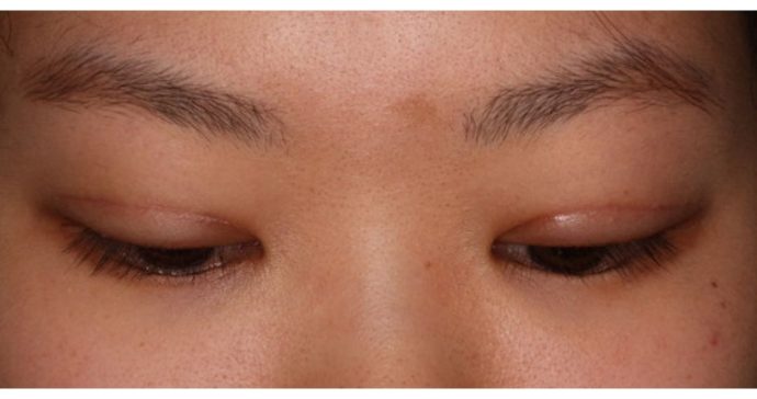 術後2週間　下方視