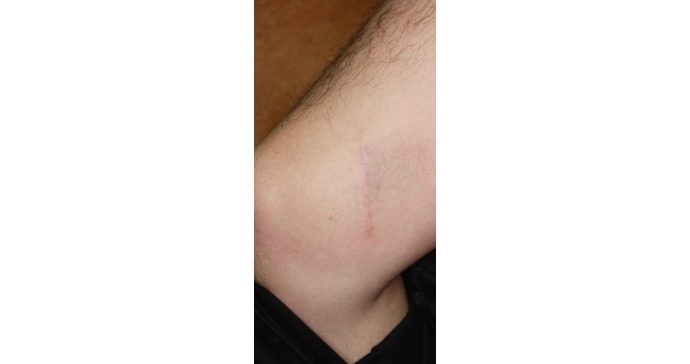 採皮部(右大腿部内側)