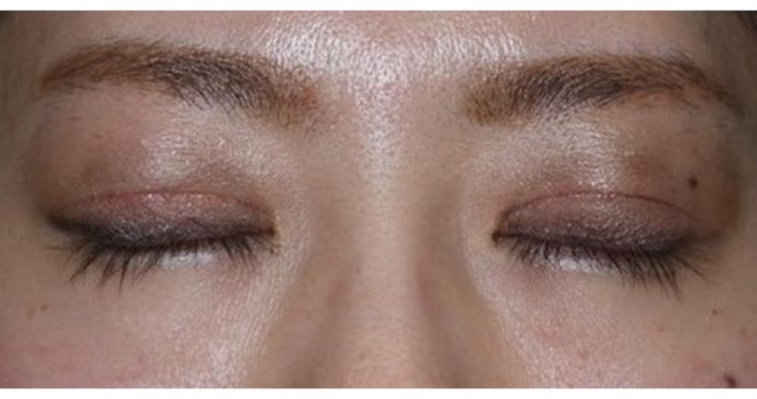 術後3ヶ月 閉瞼