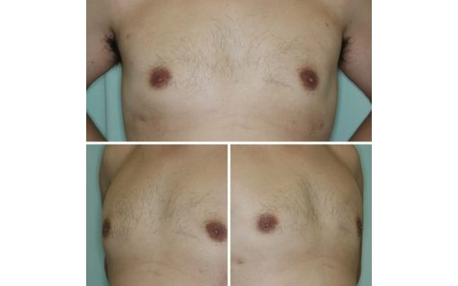 偽性女性化乳房_30代術後