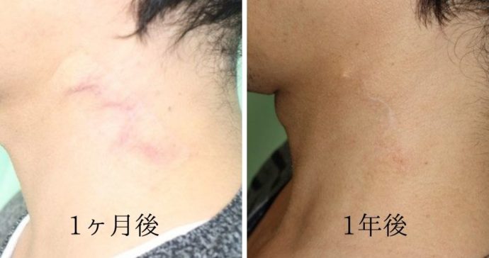 術後1ヶ月・1年後