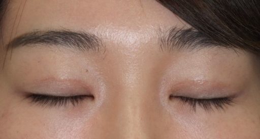 術後2ヶ月 閉瞼