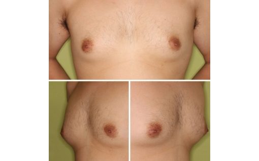 偽性女性化乳房30代術前