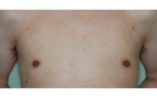 女性化乳房_脂肪吸引6ヶ月後