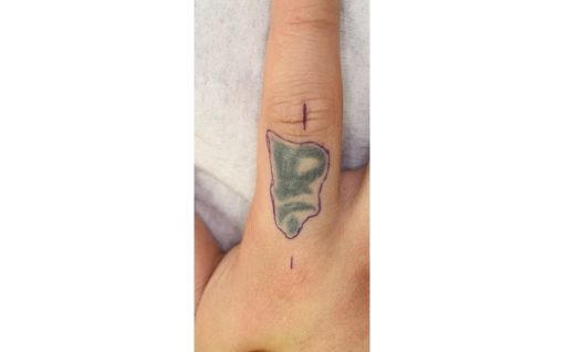 指のタトゥー除去・植皮術　術前