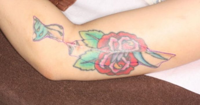 1回目手術の術後3ヶ月