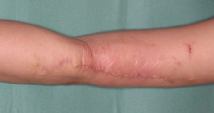 3回目手術 2週間後