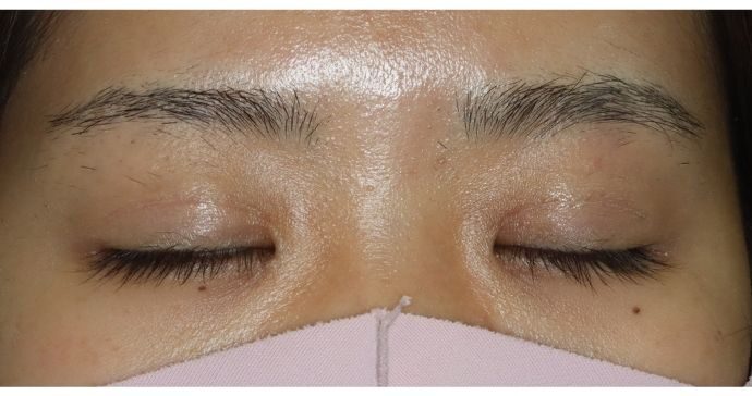 術後2ヶ月 閉瞼